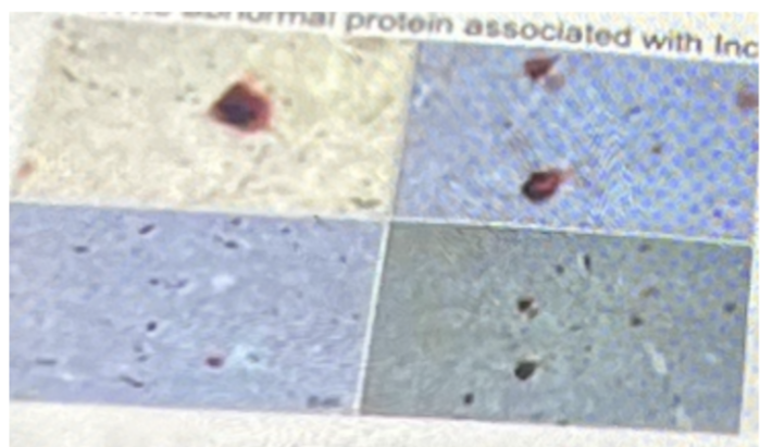 <p>The abnormal protein associated with inclusions, from substantia nigra</p><p>A- synuclein </p><p>B- amyloid </p><p>C- myelin </p><p>D- Tau </p><p>E E- Actin</p>