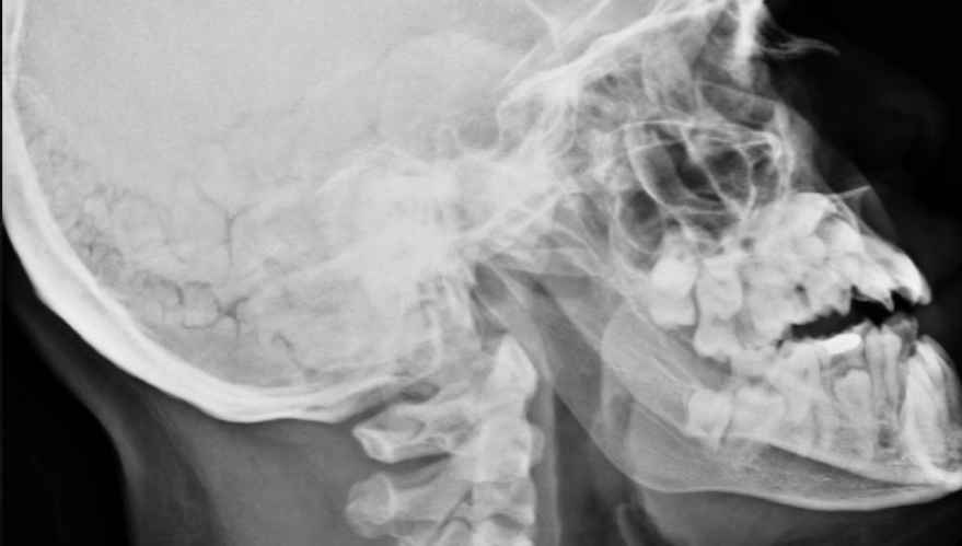 <p>what is seen here for this case of cleidocranial dysplasia?</p>