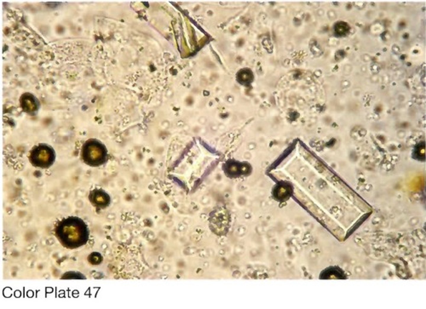 <p>A. May be found in normal alkaline urine</p>