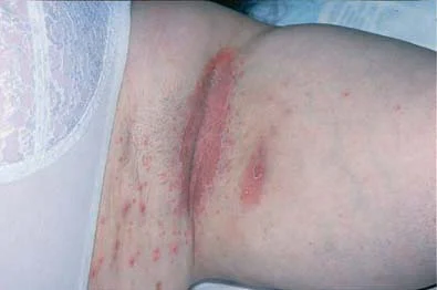 <p>fungus in skin folds</p><p>satellite pustules with erythematous macules</p>