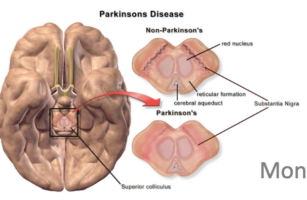 <p>caused by a loss of neurons in substantia nigra pars compacta (SNc) → dopamine producing region in tegmentum</p><ul><li><p>causes difficulty initiating voluntary, spontaneous behaviour (feel frozen), trembling of extremeties, shuffling gait, stooped posture</p></li></ul><p></p>