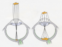 <p>change in the shape of the lens that occurs when we focus on objects at various distance.</p>