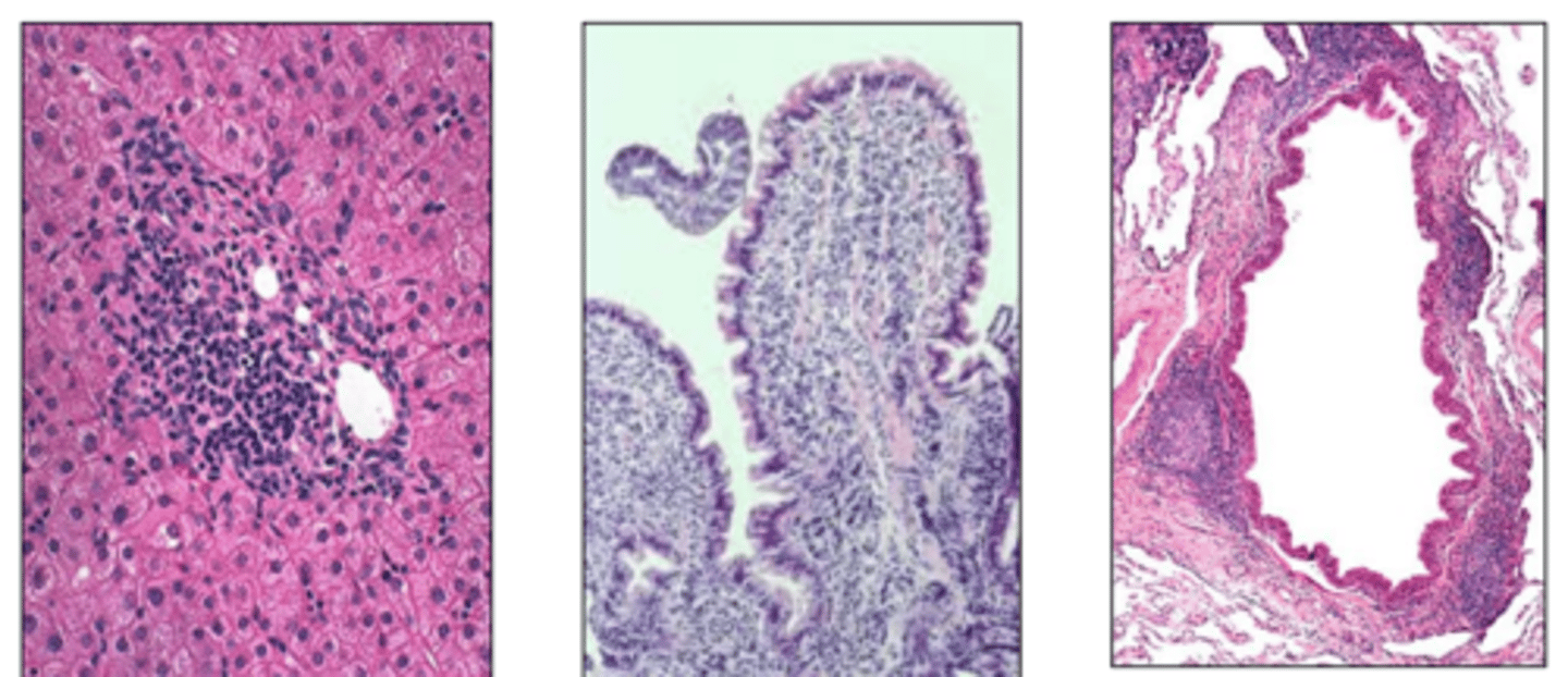 <p>what type of exudate is being shown microscopically?</p>