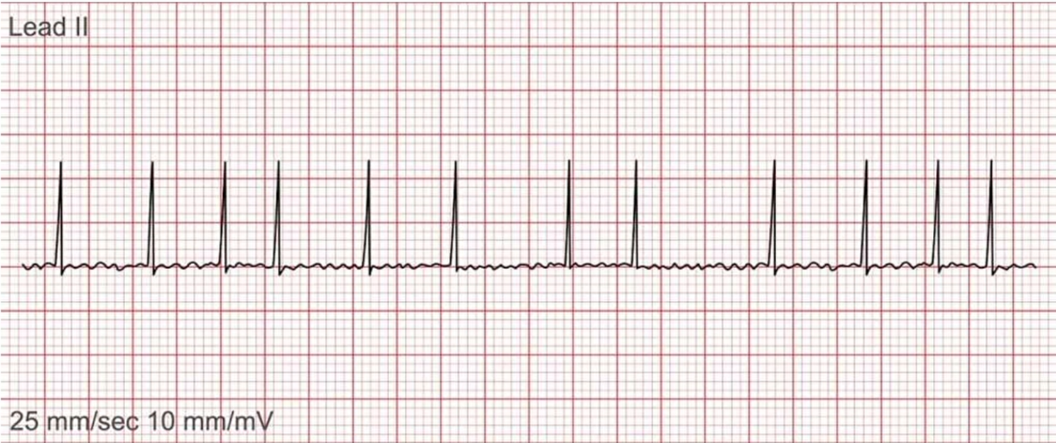 <p>What does this EKG represent?</p>