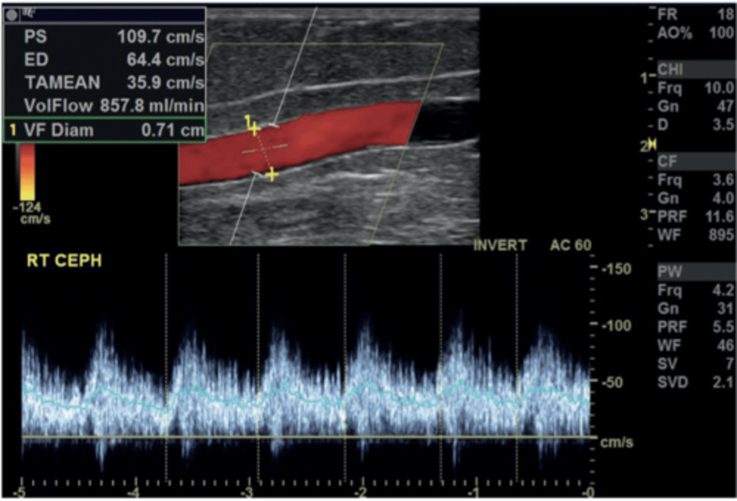 <p>Evaluate function at mid-fistula</p><p>Large sample volume (wide as vessel)</p><p>Measure diameter on grayscale</p><p>Use auto-tracing or trace 3-4 waveforms for mean velocity</p><p>Take at least 3 times</p>