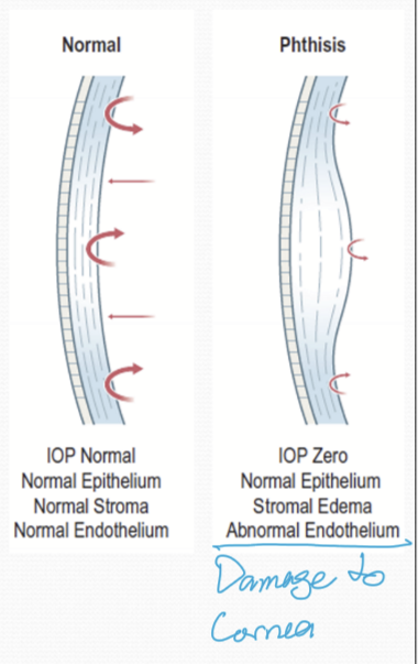 <p>IOP becomes zero and there is only stromal edema. Epithelium does not have IP, so no water is drawn into the epithelium. Over time, IP and SP will become zero.</p>