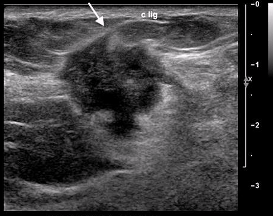 <ul><li><p>most common</p></li><li><p>found most common in UOQ</p></li></ul><p></p>