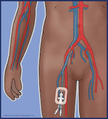 <p>Medical devices placed in the femoral artery to measure blood pressure and facilitate access for blood sampling in emergency and surgical settings. </p>