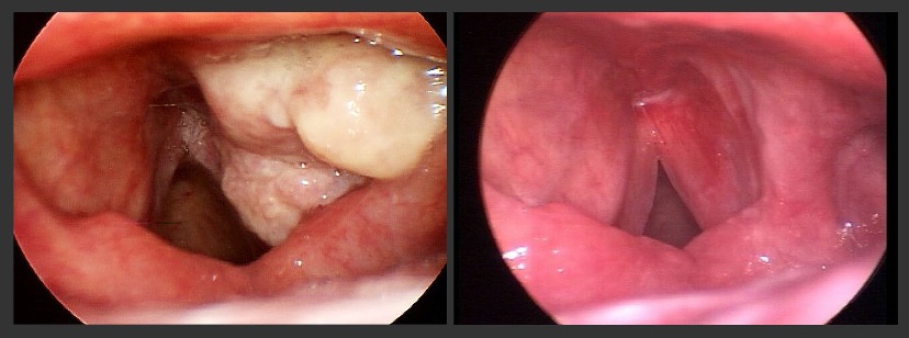 <p>most common laryngeal malignancy; voice change most common complaint</p>