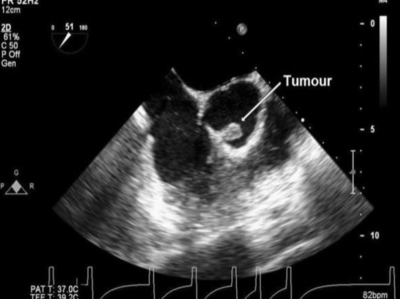 <p>Traits of Papillary Fibroelastomas:</p>