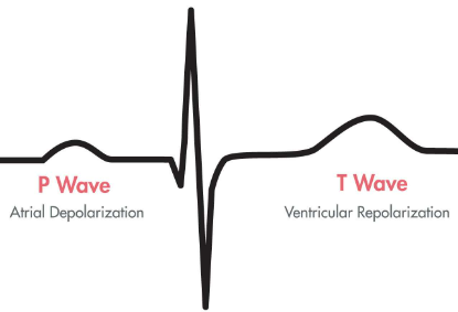 <p>sharp downward, upward, downward spike, ventricular depolarization</p>