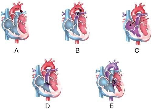 <p>Which of the labeled diagrams shows an atrial septal defect?</p><p>a) A</p><p>b) B</p><p>c) C</p><p>d) D</p><p>e) E</p>