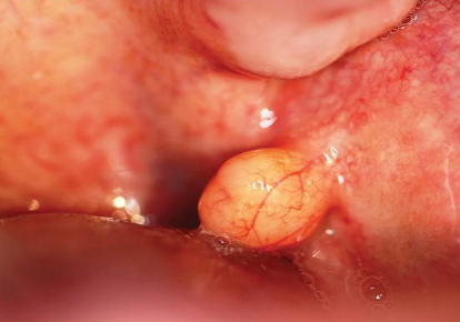 <p>soft, movable, yellowish, smooth sessile mass of buccal mucosa </p>