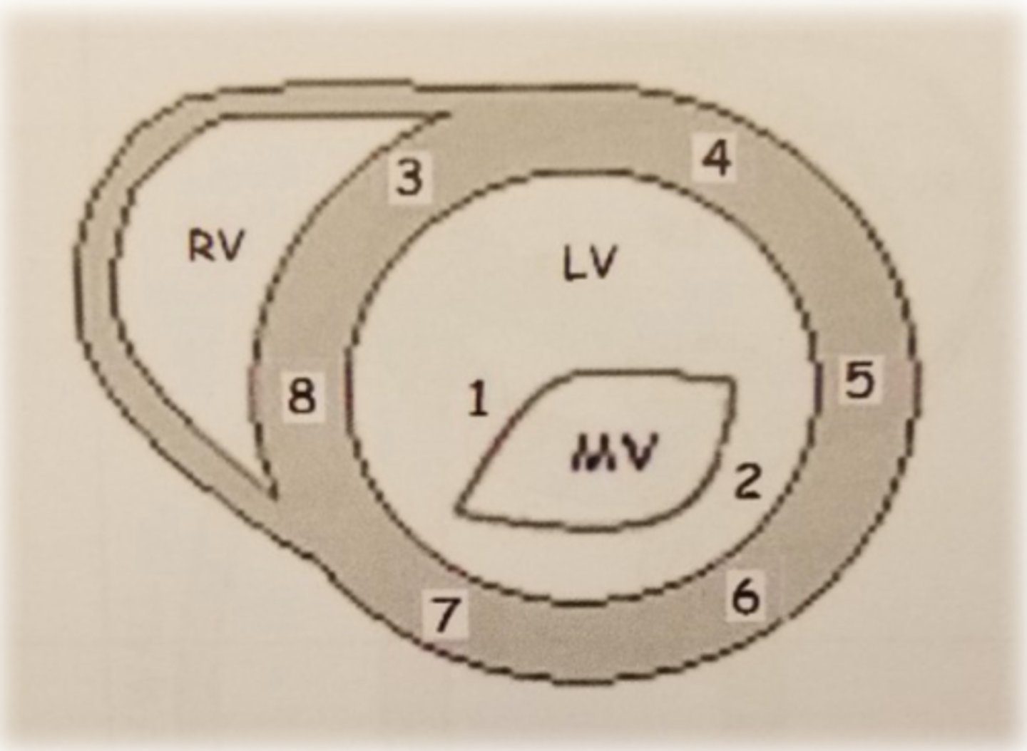 <p>anterolateral wall</p>