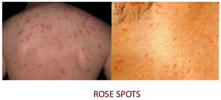 <ul><li><p><strong>"Rose rash"</strong> on the trunk in ~30% of cases, lasting <strong>3-4 days</strong>.</p></li><li><p><strong>Gastrointestinal symptoms</strong>: Starts with <strong>constipation</strong>, then progresses to <strong>diarrhea</strong>.</p></li></ul><p></p>