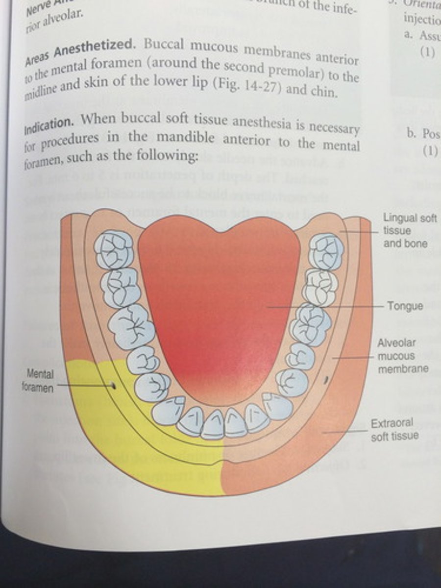 <p>first mandibular premolar to midline. No teeth are anesthetized!! Soft tissue only</p>