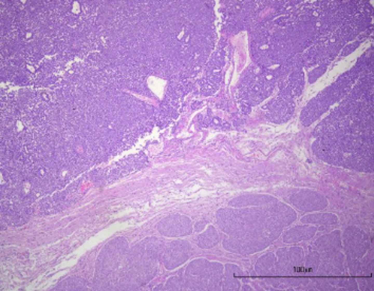 <p>What kind of tumor is this?</p>