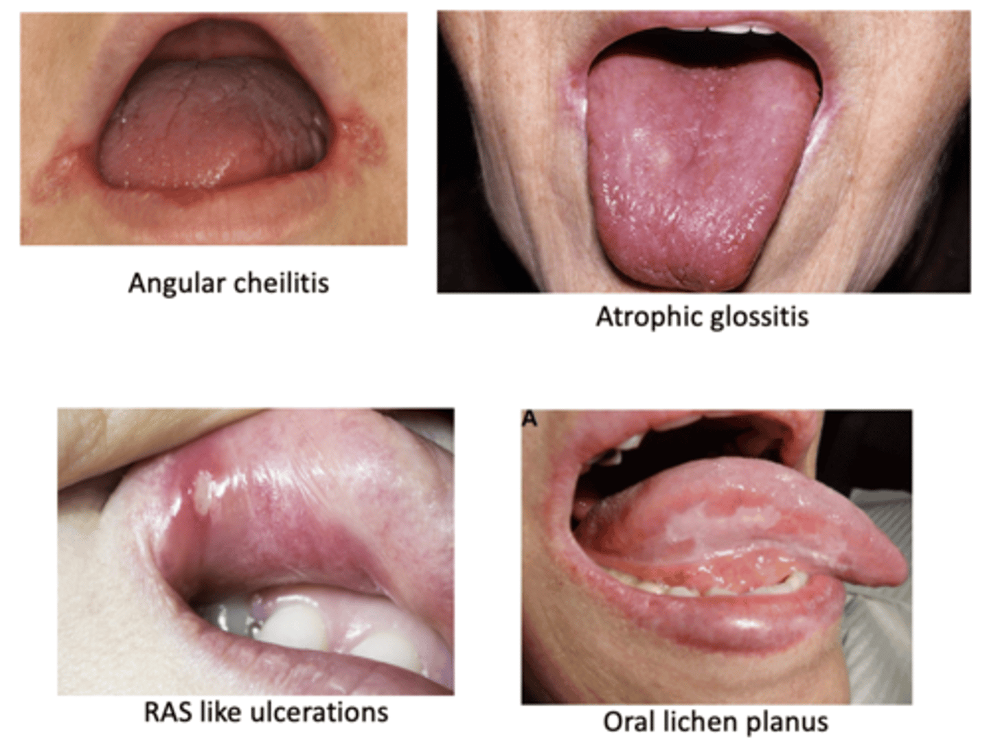<p>Signs of _____ in the mouth can cause suspicion for these conditions</p><p>• Angular cheilitis</p><p>• Atrophic glossitis</p><p>• RAS like ulcerations</p><p>• Oral lichen planus</p><p>• Xerostomia</p><p>• Numbness</p><p>• Burning sensation</p><p>• Dysgeusia (altered taste perception)</p><p>• Other symptoms/signs: Short of breath, fatigue, pallor</p>