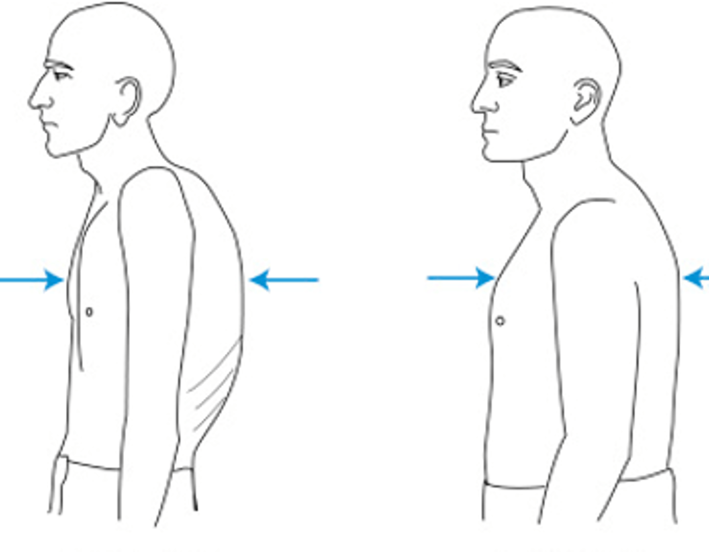 <p>What's this chest physical exam finding called (left side)? What underlying condition do they probably have?</p>