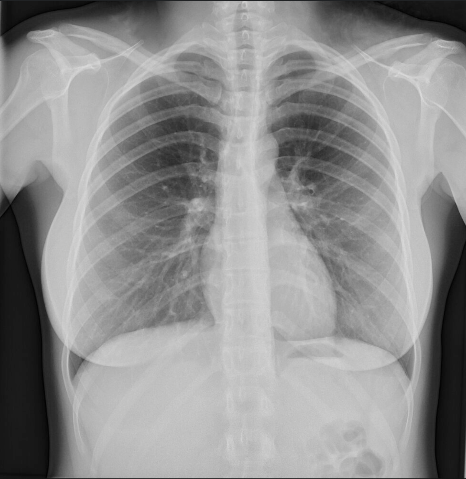 <p>D. Superior vena cava (V. cava superior)</p>