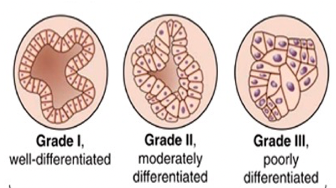 <p>Grading: Refers to the abnormality of cancer cells under the microscope. Refers to differentiation indicating how aggressive and likely to spread the cancer is.</p><p><span>-</span><span style="font-family: &quot;Times New Roman&quot;; line-height: normal; font-size: 7pt;">&nbsp;&nbsp;&nbsp;&nbsp;&nbsp;&nbsp;&nbsp; </span>Nottingham Grading: based on differentiation, nucleus and speed of cell growth indicating the aggressiveness of the cancer.</p><p class="MsoListParagraphCxSpMiddle">-NG 3-5. Grade = I</p><p class="MsoListParagraphCxSpMiddle">-NG 6-7. Grade = II</p><p class="MsoListParagraphCxSpLast">-NG 8-9. Grade = III</p>