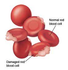 <ul><li><p>RBC’s lysing</p></li><li><p>Caused by toxic chemicals</p></li><li><p>Can happen with Chemotherapy.</p><ul><li><p>Chemotherapy drugs target any cells that are actively dividing, But your Red Bone Marrow is dividing which will drop your blood count. Red bone marrow is your stem cells which is crucial for production of blood cells.</p></li></ul></li></ul>