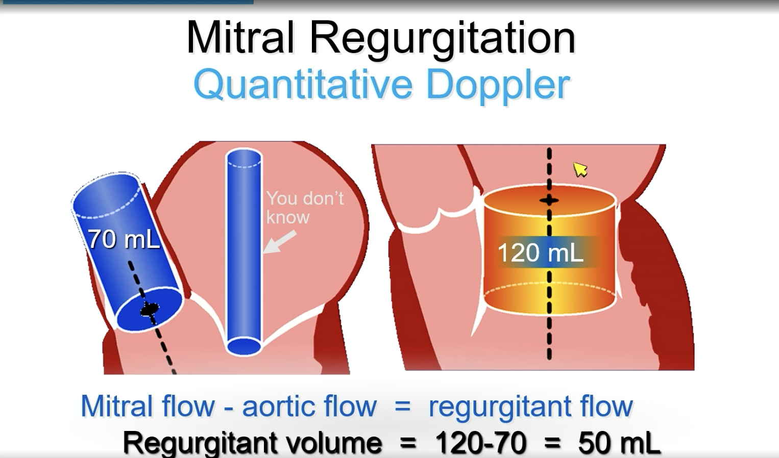 <p>FYI Continuity Equation</p><p></p><p>SV = Area x VTI </p><p>Calculate at each orifice then subtract for regurgitant flow.</p><p></p><p>Mitral flow - aortic flow = regurgitant flow</p>