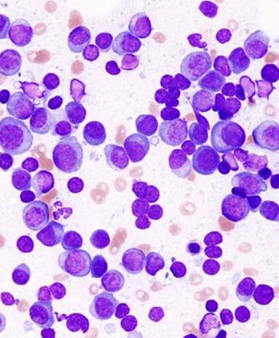 <p><span>neoplastic population of plasma cells or immunoglobulin-producing B-lymphocyte precursor lineage</span><br><br><span>most are monoclonal</span></p>