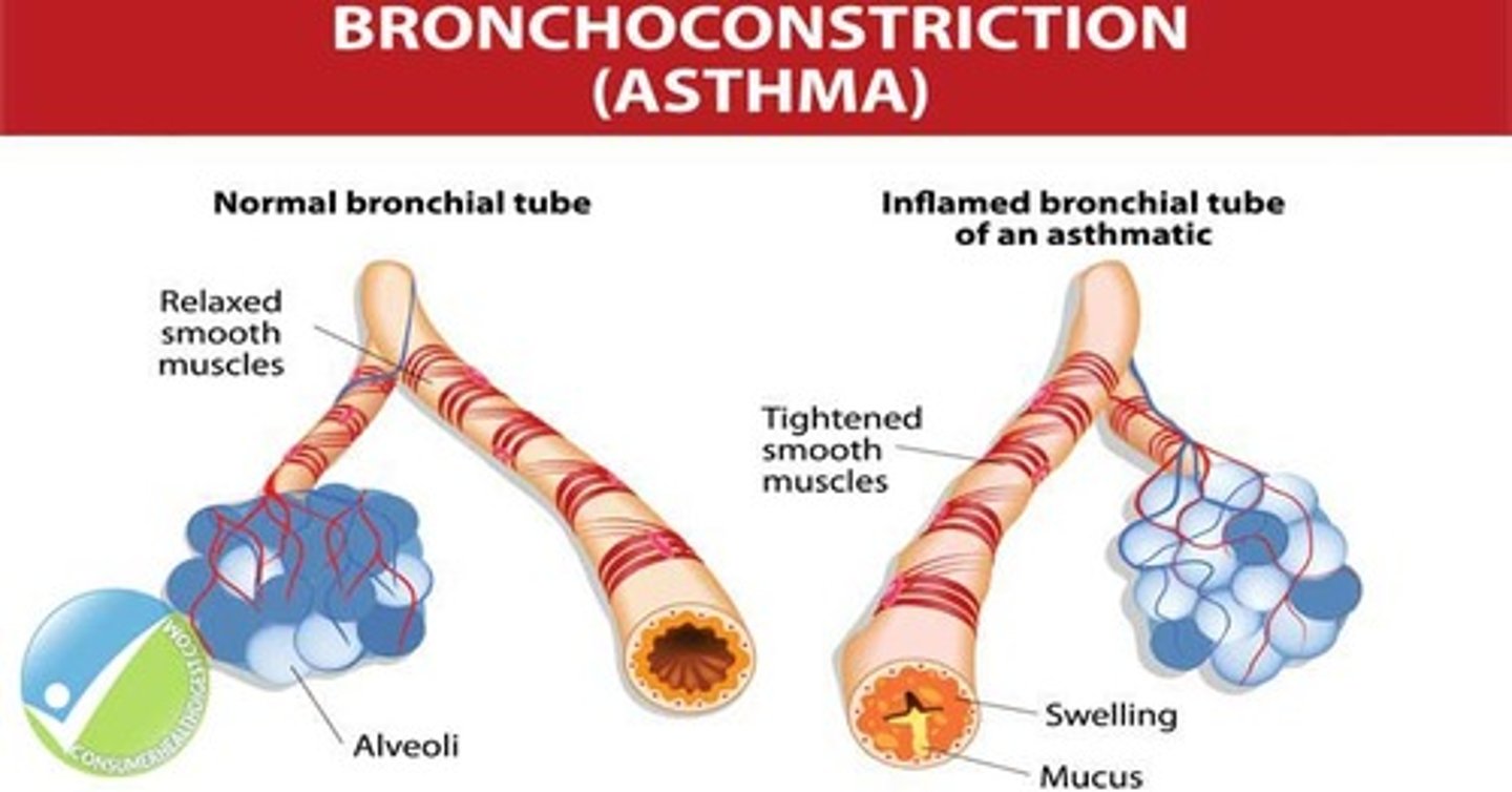 <p>a condition that narrows the breathing passages and makes it difficult to breathe, caused by a spasm of the muscle lining in the bronchi and excess mucus.</p>