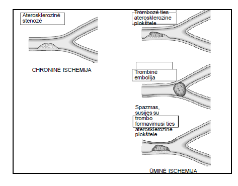 <p>Arterijos spindžio susiaurėjimas (dėl aterosklerozinės plokštelės)</p><p>Spindžio užsikimšimas trombu ar embolu.</p><p>Užspaudus spindį iš išorės naviku, hematoma, randu Ilgiau užtrukus spazmui</p>