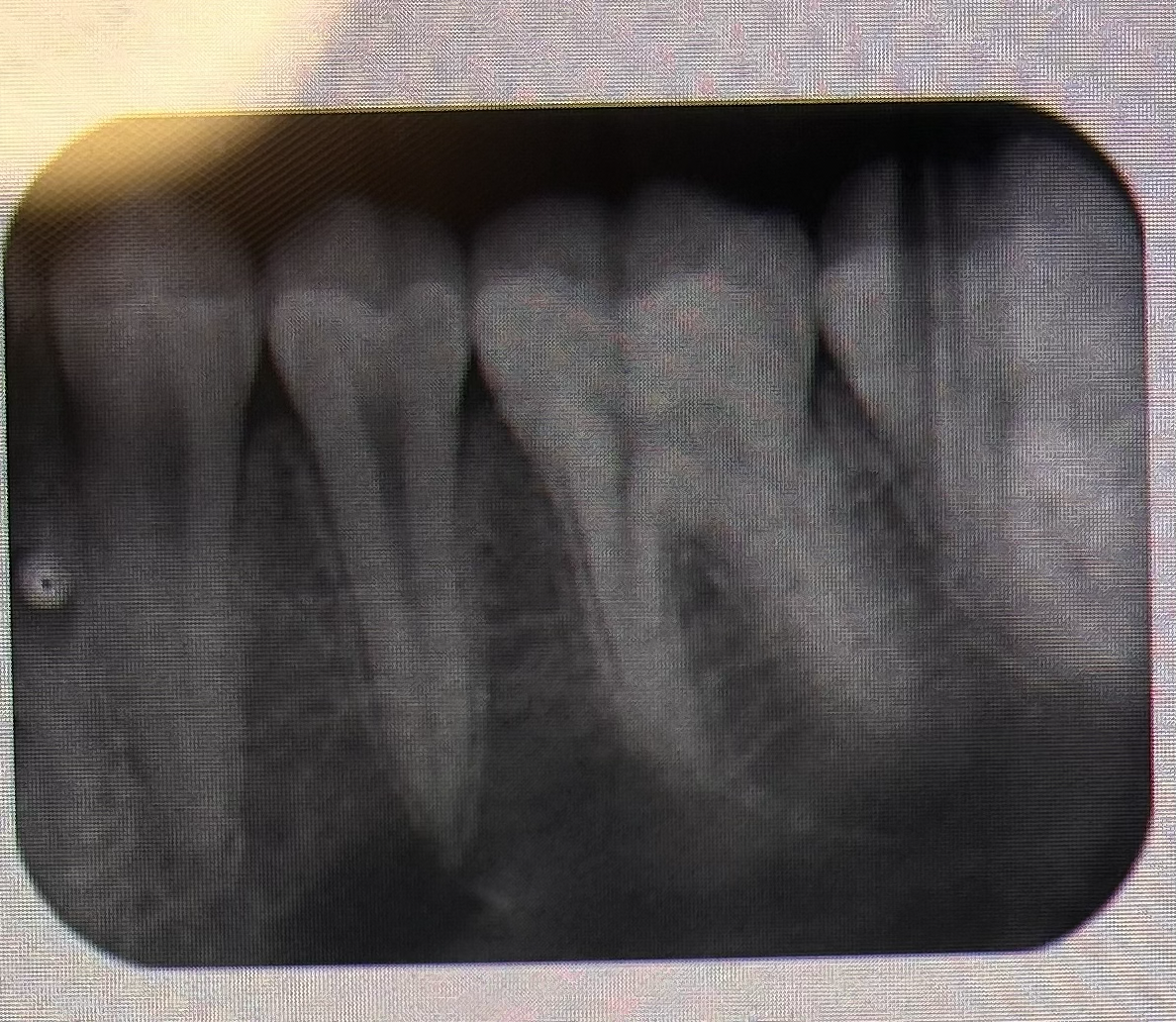 <p>THE PROCESSING ERROR DEPICTED IN THE PICTURE CAN BE DESCRIBED AS WHAT? THE CAUSE WAS DUE TO:</p>