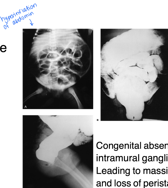 <p>A congenital absence of intramural ganglion leading to massive dilation, and loss of peristalsis</p>
