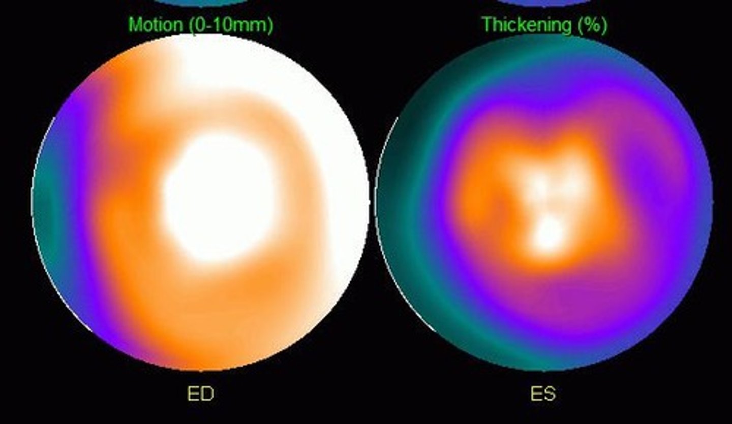 <p>Additional functional information by synchronizing SPECT acquisition to the patient's ECG.</p>