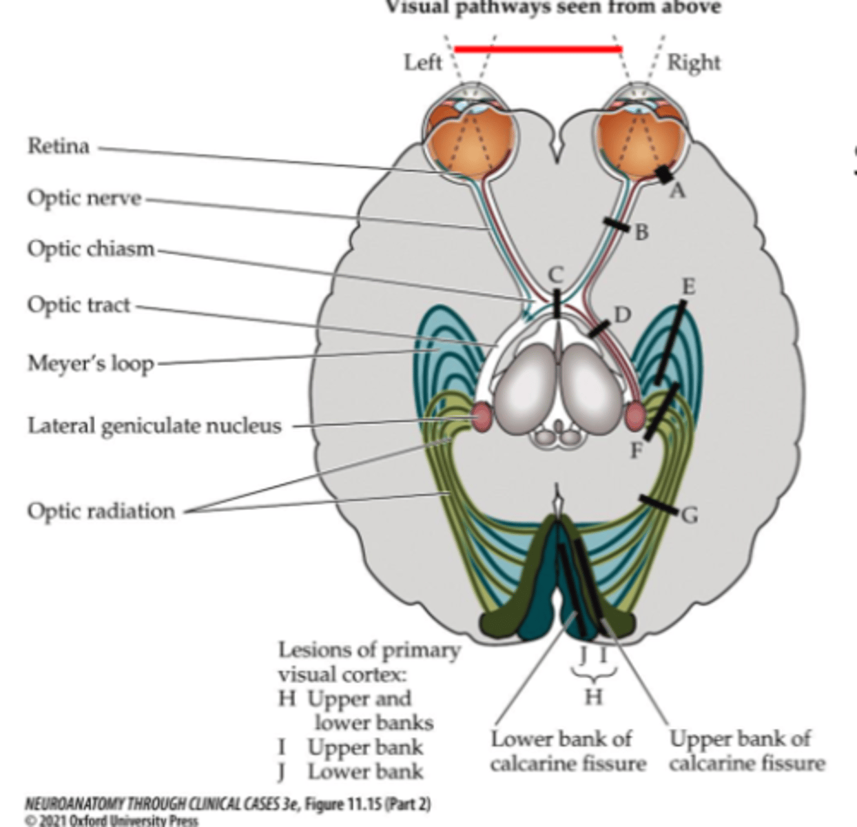 <p>Right optic radiation</p>