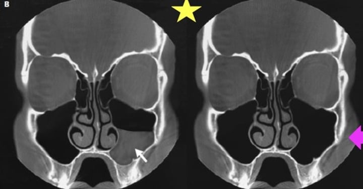 <p>Identify the radiographic abnormality on the left x-ray.</p>