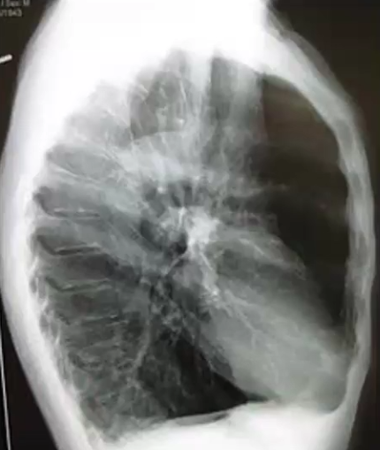 <ul><li><p>Emphysema is an irreversible enlargement of the air spaces distal to the terminal bronchioles (air sac, alveoli, alveolar ducts) accompanied by destruction of their walls without fibrosis</p></li><li><p>Cigarette smoking is the primary cause, followed by <strong>alpha1 antitrypsin (At1) deficiency</strong> (antiproteases defective cant fight oxidative stress)</p></li><li><p>Pathogenesis: Noxious inhalation (or infection) causes too much <strong>oxidative damag</strong>e and destructs lung alveoli, leading to <strong>decreased elastic recoi</strong>l and <strong>overexpanded lungs</strong></p></li><li><p>Types: Centrilobular emphysema affects primarily the upper lobes, Pacinar Emphysema affects both upper and lower</p></li><li><p>Clinical Features: Lungs are overinflated (“<strong>barrel chest</strong>”), diaphragm is depressed, pursed lip breathing (“<strong>pink puffers</strong>”) due to exertional dyspnea, can lead to Cor pulmonale</p></li></ul><p></p>