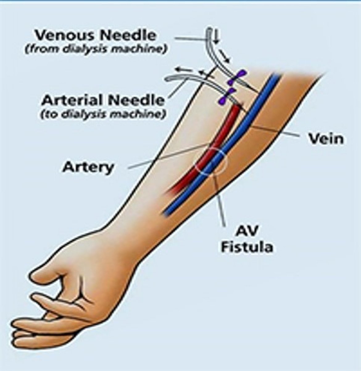 <p>A ___________ is a surgically created communication between the native artery and the vein in an extremity.</p>