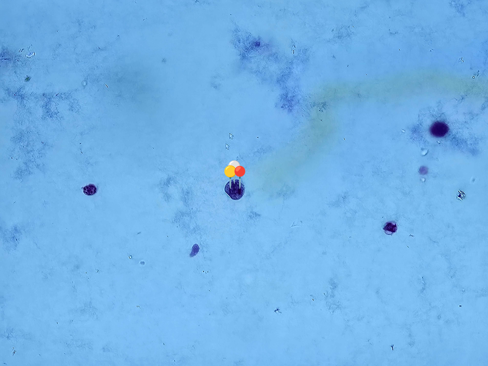 <p><strong><em>Entamoeba histolytica</em></strong></p><p>(Cysta)</p><p></p><p></p><p><strong>Organelle:</strong></p><p></p><ul><li><p><span data-name="red_circle" data-type="emoji">🔴</span> - ciałko chromatoidalne;</p></li></ul><p></p><ul><li><p><span data-name="yellow_circle" data-type="emoji">🟡</span><span data-name="white_circle" data-type="emoji">⚪</span> - jądra komórkowe.</p></li></ul><p></p><p></p><p><strong>Parazytoza: </strong><em>Pełzakowica</em></p>