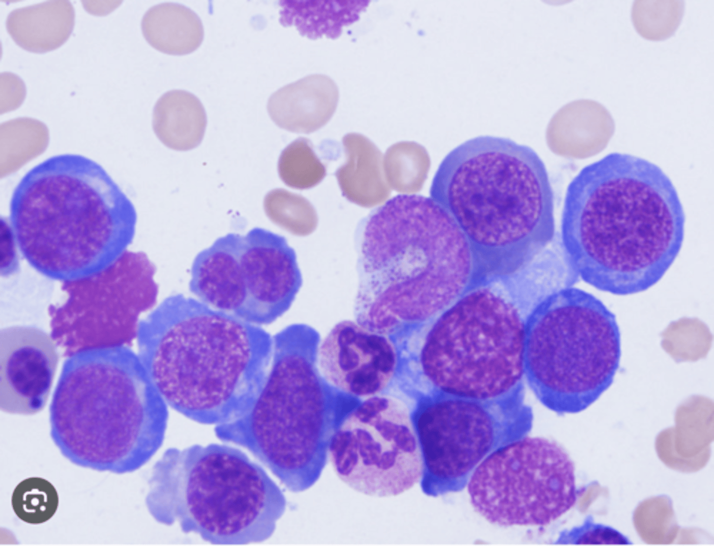 <p>Hémogramme : </p><p>Anémie macrocytaire normochrome arégénérative</p><p>+/- leucopénie, thrombopénie, neutropénie....</p><p>Frottis : </p><p>Anisocytose, macrocytose</p><p>PNN avec 5 lobes (au lieu de 3)</p><p>Syndrome d'hémolyse : </p><p>↗ bilirubine libre, LDH</p><p>↘ haptoglobine</p><p>Dosage B9 et B12 : avant traitement </p><p>les normes ne sont pas à connaitre </p><p>Myélogramme : aspect de mégaloblastose (photo)</p>