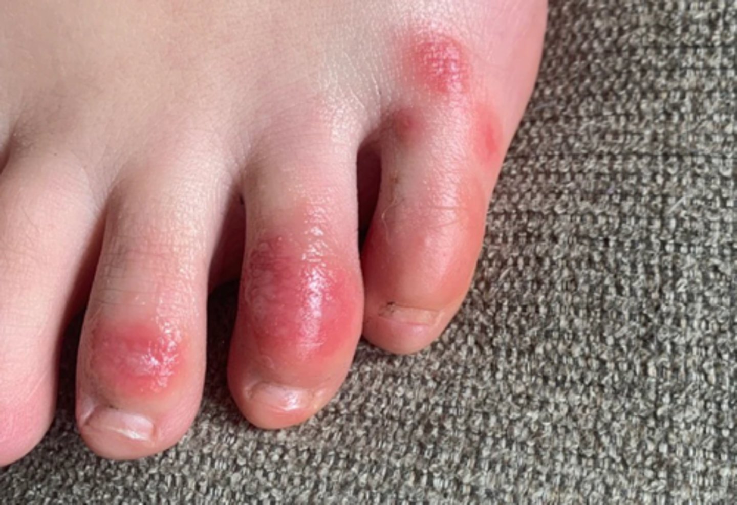 <p>thought to be an immune response to COVID, where the toes swell, become red, and the skin blisters possibly turning purple</p>
