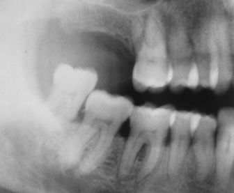 <p>The maxillary 2nd &amp; 3rd molars have been missing for several years. What has happened to the mandibular 3rd molar?</p><p>&nbsp;</p><p>partially extracted</p><p>&nbsp;</p><p>dens evaginatus</p><p>&nbsp;</p><p>supraeruption (extrusion)</p><p>&nbsp;</p><p>floating tooth</p>