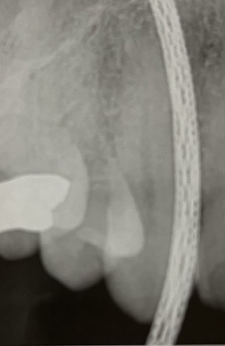 <p>intraoral sensor is linked to the computer via a fiberoptic cable; sensor is placed with the cable between the sensor and the source of radiation</p>