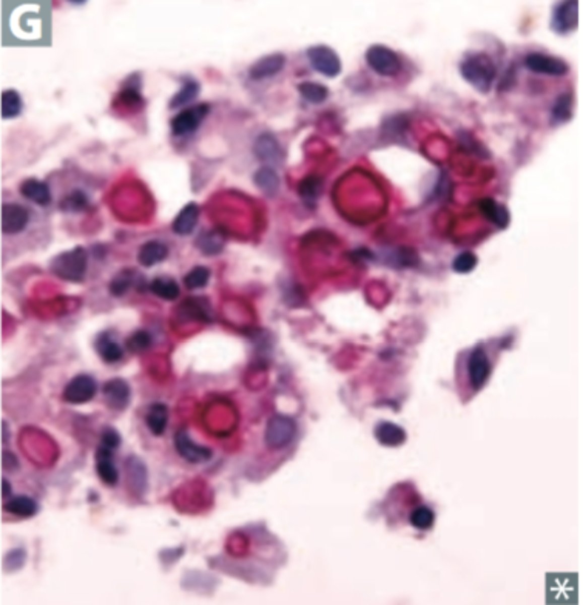<p>What diagnostic characteristics are seen with Cryptococcal meningitis (mainly seen in immunocompromised pts - HIV POSITIVE)?</p>