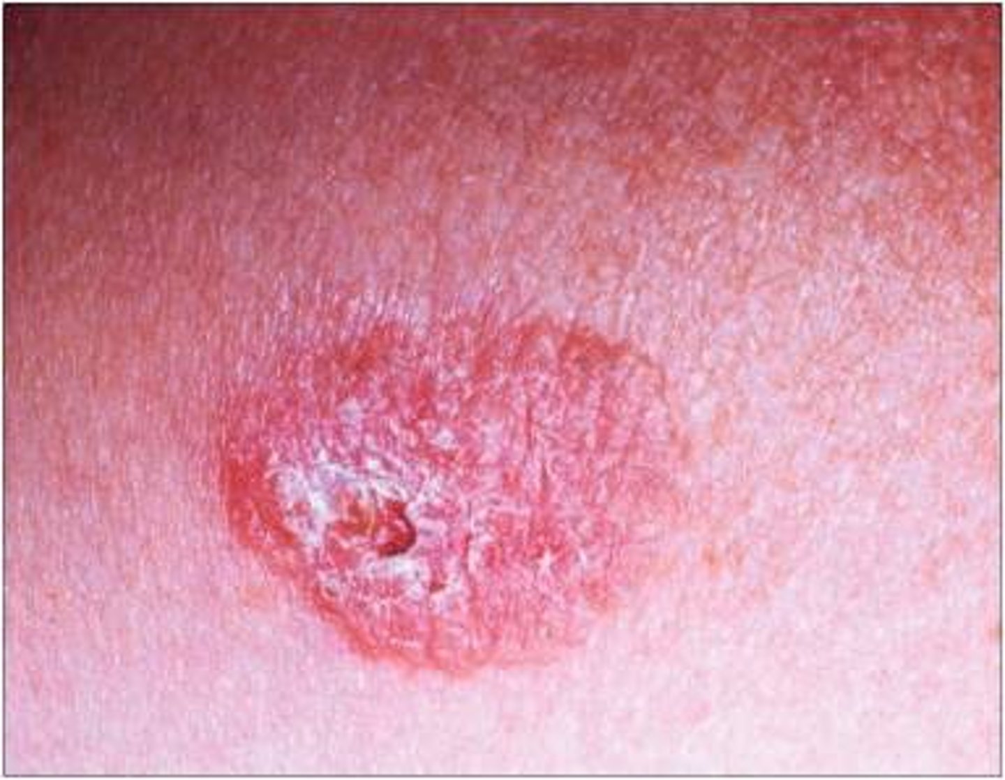 <p>Bowen's Disease (SCC in Situ)</p>