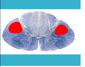 <p>more laterally and posteriorly in the lateral funiculus </p>