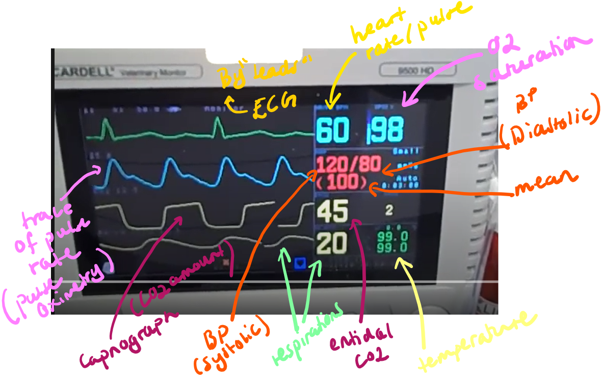 <p><strong>Monitoring vital signs and other parameters</strong> is essential for patient safety throughout the entire anesthetic process. </p><p><span style="color: blue"><strong>Capnometry and Capnography</strong></span></p><ul><li><p class="text-primary-foreground"><strong>Capnometry</strong> real time info on respiratory rate, end-tidal carbon dioxide (ETCO₂) and inspired CO2. </p></li><li><p class="text-primary-foreground"><strong>Capnography</strong> is the continuous graphic representation of these measurements, showing the CO₂ concentration throughout the respiratory cycle. (amount of CO2 expired, sampled)</p></li><li><p><strong>Waveform Phases:</strong></p><ul><li><p><strong>Phase 1 (Inspiratory Baseline):</strong> beginning of exhalation, usually at 0 mmHg CO₂ as it's dead space air from the airways.</p></li><li><p><strong>Phase 2 (Expiratory Upstroke):</strong> As more alveolar air is exhaled, CO₂ levels rapidly increase.</p></li><li><p><strong>Phase 3 (Expiratory Plateau):</strong> Represents the even expiration of CO₂ from the alveoli, 30-40 mmHg.</p></li><li><p><strong>Phase 0 (Inspiratory Downstroke):</strong> A rapid decrease in CO₂ as the patient inhales fresh gas containing no CO₂.</p></li></ul></li><li><p><strong>Significance:</strong> Changes in the capnogram waveform or ETCO₂ values can indicate problems such as airway obstruction, rebreathing of CO₂, leaks in the breathing circuit or endotracheal tube cuff, respiratory arrest, or even issues with cardiac output. </p></li></ul><p><span style="color: purple"><strong>Pulse Oximetry</strong></span></p><ul><li><p class="text-primary-foreground">non-invasive technique that provides real-time determination of oxygen saturation in arterial blood (SpO₂).</p></li></ul><ul><li><p><strong>What it Measures:</strong> The percentage of hemoglobin saturated with oxygen (SpO₂), and often also provides the heart rate. </p></li><li><p><span style="color: #e69e9e"><em>Normal SpO₂ in an anesthetized patient breathing 100% oxygen should be 98-100%. </em></span></p></li><li><p><span style="color: #e69e9e"><em>An SpO₂ of 90% corresponds to a PaO₂ of 60 mmHg, indicating hypoxemia.</em></span></p></li><li><p><strong>How it Works:</strong> The machine sends infrared light at two wavelengths (660 nm for deoxygenated blood and 940 nm for oxygenated blood) through the blood and tissues. </p><ul><li><p>By measuring the absorption at each wavelength, it calculates the percentage of oxygen in the blood.</p></li></ul></li><li><p><strong>Significance:</strong> Ensures the patient is receiving adequate oxygen and that oxygen is effectively reaching the tissues.</p></li><li><p>The probe requires a warm, motionless, non-pigmented, and lightly haired site for accurate readings, such as the tongue, ear, prepuce, or toe web. </p></li></ul><p><span style="color: green"><strong>Blood Gas Analysis</strong></span></p><ul><li><p class="text-primary-foreground">for assessing the patient's acid-base status, the adequacy of ventilation (through PaCO₂), and the level of oxygenation (through PaO₂).</p></li></ul><p><span style="color: green"><strong>Arterial Blood Pressure</strong></span></p><ul><li><p class="text-primary-foreground">one of the most important measures of cardiovascular function, indicating the adequacy of blood flow to the patient's tissues and organs.</p></li></ul><ul><li><p><strong>Normal Ranges During Surgery: BP - 120/80 mm Hg.</strong></p><ul><li><p>Systolic: 90-120 mmHg</p></li><li><p>Diastolic: 55-90 mmHg</p></li><li><p>Mean Arterial Pressure (MAP): 60-100 mmHg </p></li></ul></li><li><p><strong>How it's Measured:</strong></p><ul><li><p><strong>Invasively:</strong> by catheter</p></li><li><p><strong>Non-invasively: Doppler technique or Oscillometer</strong></p></li></ul></li></ul><p><span style="color: #530d0d"><strong>Electrocardiography (ECG)</strong></span></p><ul><li><p class="text-primary-foreground">monitoring of the electrical activity of the heart. The electrocardiogram (ECG) is a graphic representation of the sum of electrical potentials generated by the heart during a cardiac cycle.</p></li></ul><ul><li><p><strong>What it Measures:</strong> Heart rate and rhythm.</p></li><li><p><strong>Components:</strong></p><ul><li><p><strong>P-wave:</strong> Represents depolarization (contraction) of the atrial tissue.</p></li><li><p><strong>QRS Complex:</strong> Represents depolarization (contraction) of the ventricles.</p></li><li><p><strong>T-wave:</strong> Represents repolarization (relaxation) of the ventricles.</p></li><li><p><strong>P-Q Interval:</strong> Represents the time it takes for electrical impulses to travel from the atria through the AV node and His bundle to the ventricles.</p></li></ul></li></ul><p><span style="color: #500b58"><strong>Body Temperature</strong></span></p><ul><li><p>The core body temperature of the patient, measured by rectal thermometer or more continuosly with an esophageal or nasopharyngeal probe. </p></li><li><p>During anesthesia, the body temperature usually decreases due to muscle inactivity, reduced metabolic rate, drug induced vasodilation + depression of thermoreg. centre. </p><ul><li><p><span style="color: #d69c9c"><em>hypothermia: prolonged drug metabolism + recovery, cardiac dysfunction, impaired perfusion, risk of infection.</em></span></p></li><li><p><span style="color: #d69c9c"><em>Hyperthermia (less common): neurological damage.</em></span></p></li></ul></li></ul><p></p>