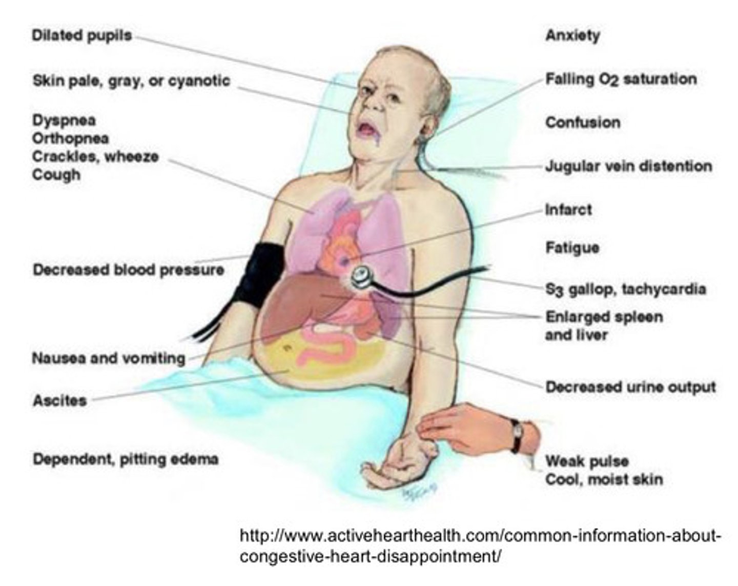 <p>both ventricles fail, paroxysmal nocturnal dyspnea, dyspnea at rest, dysrhythmias, cardiogenic shock</p>