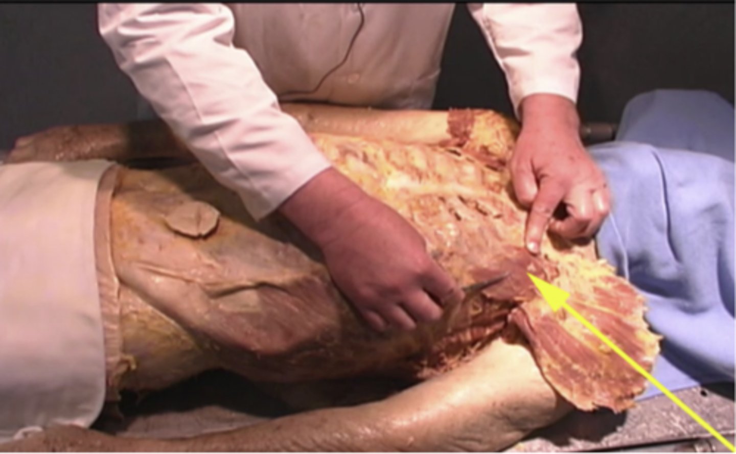 <p>What structure is being shown here?</p><p>nerve bundle</p><p>pectoralis minor</p><p>pectoralis major</p><p>spine</p>