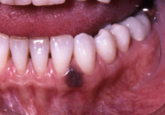 <p>what is this lesion </p>