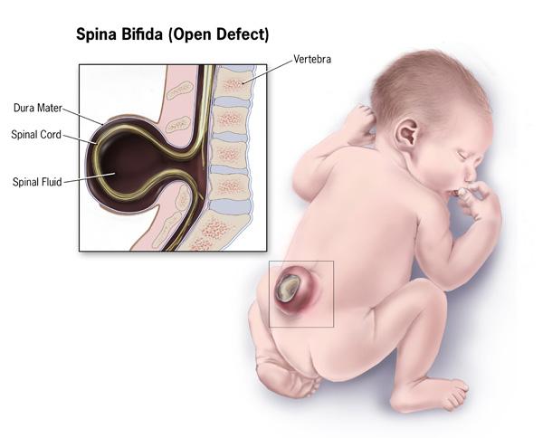 <p>megaloblastic anemia, neural tube defects (defects of brain, spine, spinal cord) (spina bifida, anencephaly)</p>